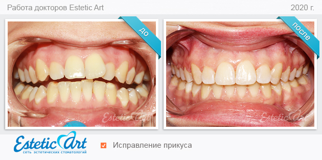 Выравнивание зубов элайнерами: до и после