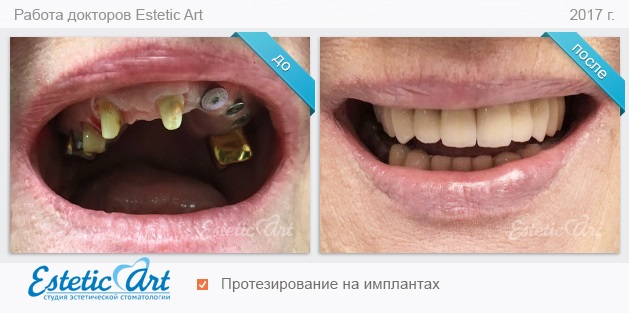 Имплантация 1 зуба, цена от ₽ в Санкт-Петербурге